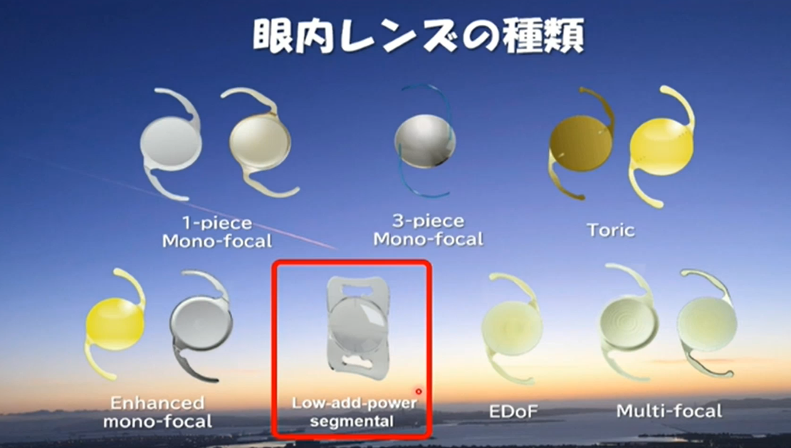 参天 保険適用老視矯正IOLによる白内障手術レベルアップ - 眼科医のブログ
